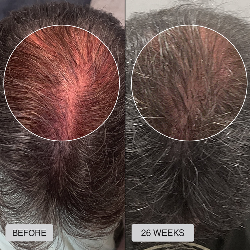 The RESTORED Hair Growth System