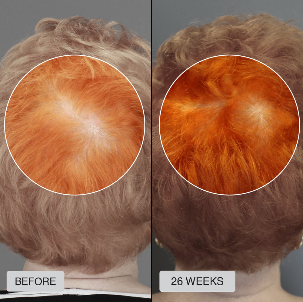 The RESTORED Hair Growth System