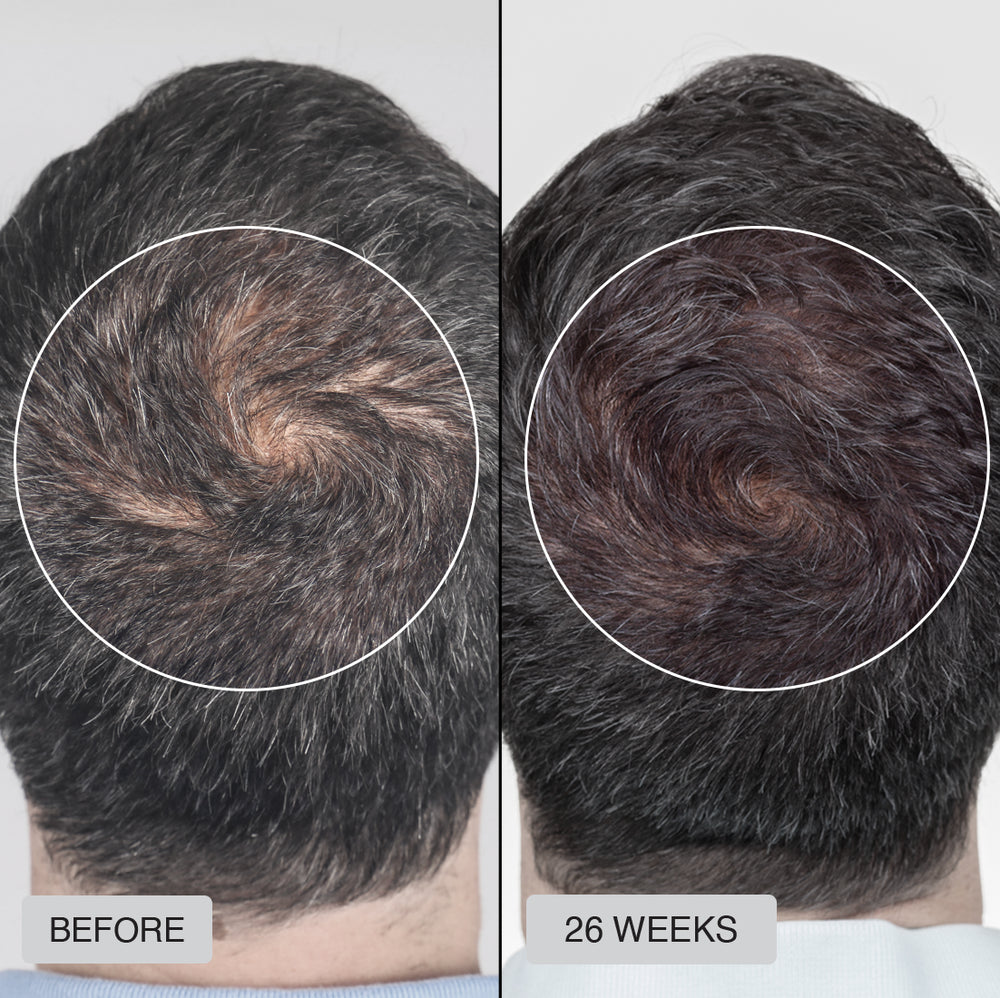 The RESTORED Hair Growth System